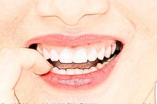 2024福州登特口腔醫(yī)院隱形矯正價(jià)格(價(jià)目)_案例_