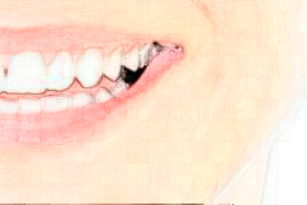 2024福州登特口腔醫(yī)院隱形矯正價(jià)格(價(jià)目)_案例_