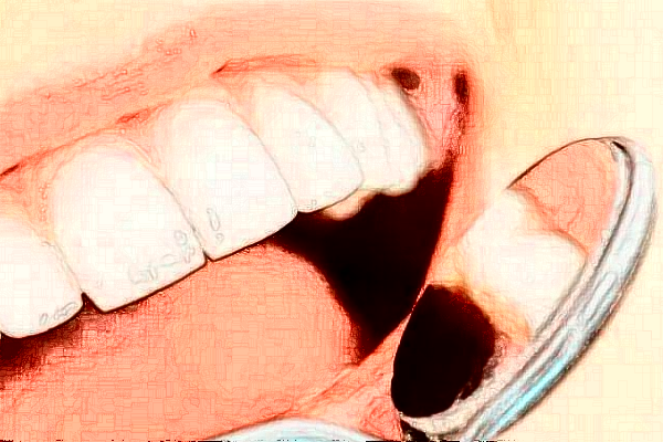 2024杭州雅萊口腔鑲牙好嗎|專家醫(yī)生|案例分享