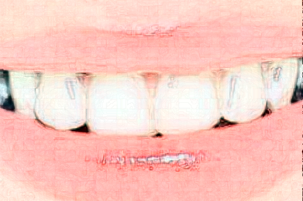 延安牙衛(wèi)士口腔樹脂補(bǔ)牙價格(價目)_案例_