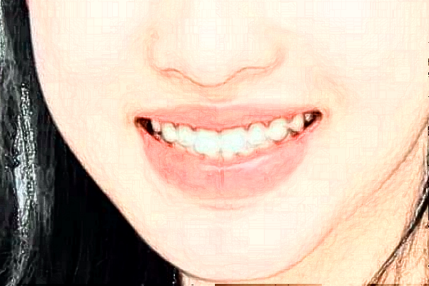 中山香山口腔醫(yī)院拔智齒疼嗎?有沒有什么危險(xiǎn)?