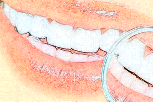 2024深圳樂(lè)莎莎口腔醫(yī)院隱形矯正價(jià)格?隱形矯正的優(yōu)點(diǎn)