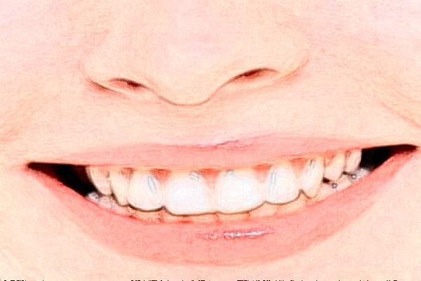 成都圣貝牙科醫(yī)院全口種植價(jià)格多少?整形日記全過程分享