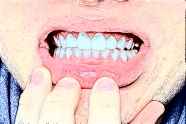 鄭州唯美口腔醫(yī)院種植牙價格多少?整形日記全過程分享