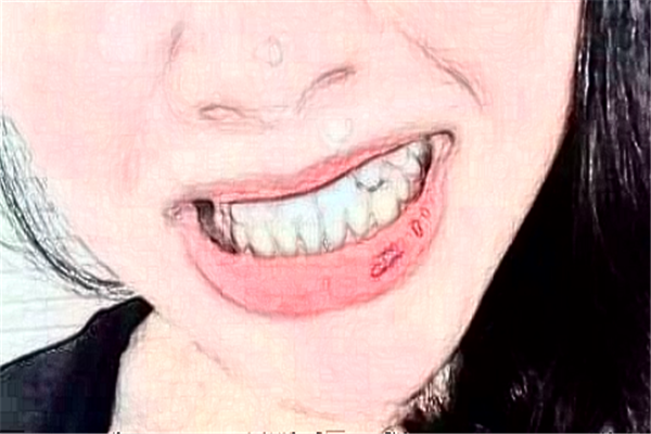 杭州雅萊口腔烤瓷牙貴不貴?案例緊跟一覽!