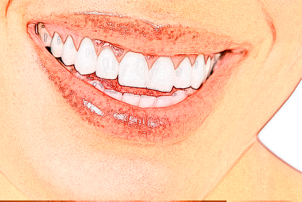 中山香山口腔醫(yī)院怎么樣?補(bǔ)牙后一般能維持幾年