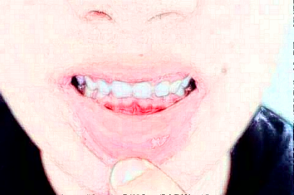 重慶團圓口腔醫(yī)院正畸到底好不好?2024正畸牙齒的費用