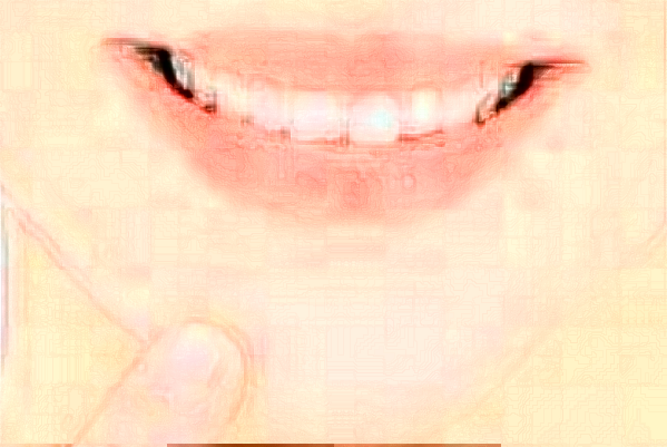 2024重慶團(tuán)圓口腔醫(yī)院隱形矯正費用?隱形矯正的優(yōu)點