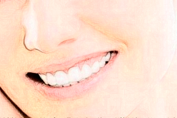 2024深圳樂莎莎口腔醫(yī)院拔牙費用?拔牙后注意事項