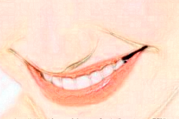 2024深圳樂莎莎口腔醫(yī)院拔牙費用?拔牙后注意事項