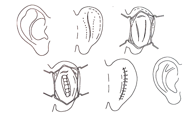 長(zhǎng)春韓合愛(ài)心整形醫(yī)院杯狀耳整形價(jià)格明細(xì)?一年案例恢復(fù)過(guò)程
