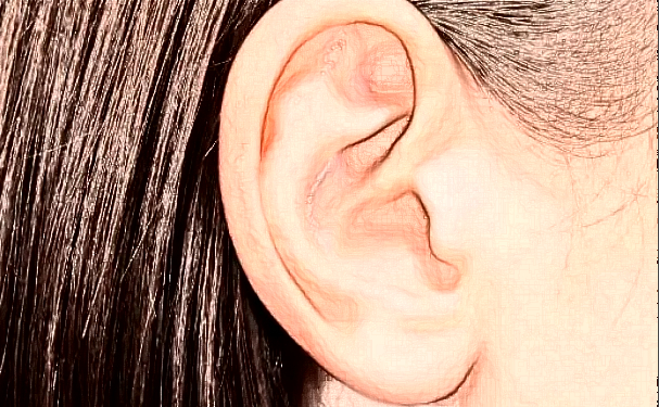 南寧夢想醫(yī)療美容門診部耳朵整形費(fèi)用明細(xì)?150天術(shù)后案例展示