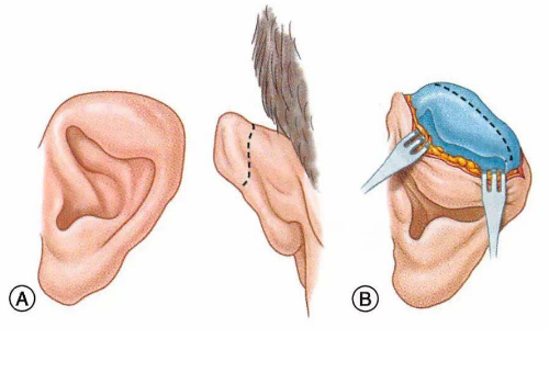 重慶瑪恩醫(yī)療美容醫(yī)院杯狀耳矯正術(shù)后半年求美案例&費(fèi)用標(biāo)準(zhǔn)?