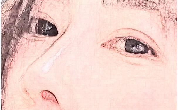 成都煥顏醫(yī)療美容整形醫(yī)院硅膠隆鼻術(shù)后三個月案例反饋&技術(shù)怎么樣?