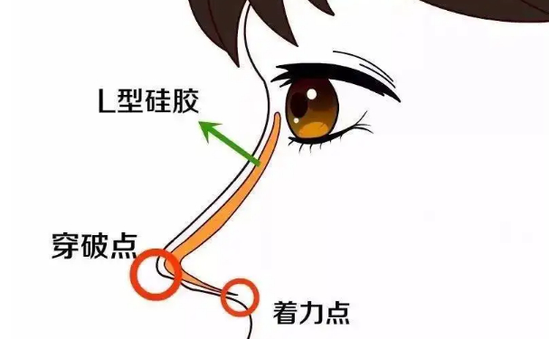 昭通民眾醫(yī)院隆鼻手術(shù)術(shù)后半年案例欣賞|技術(shù)評價(jià)怎么樣?價(jià)格查詢