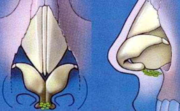 鄭州市蘊(yùn)美醫(yī)療美容耳軟骨隆鼻術(shù)后三個(gè)月案例欣賞&技術(shù)怎么樣?