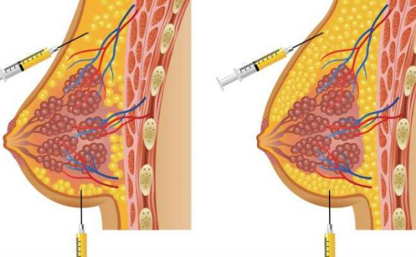 成都臻瑞新美整形醫(yī)院注射隆胸收費(fèi)標(biāo)準(zhǔn)?術(shù)后半年恢復(fù)案例