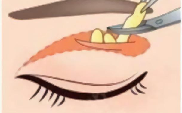 沈陽(yáng)和平和顏仙島醫(yī)療美容診所微創(chuàng)雙眼皮術(shù)后半年案例曝光(效果怎么樣?技術(shù)水準(zhǔn))