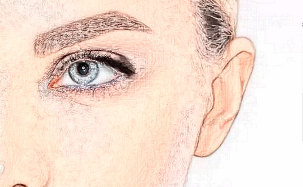 沈陽碧航醫(yī)療診所定點雙眼皮半年術(shù)后案例反饋&技術(shù)怎么樣?