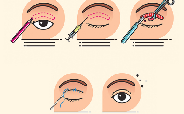 常州102醫(yī)院全切雙眼皮價格表?技術優(yōu)點怎么樣?