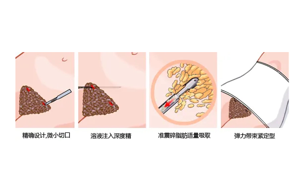佛山順德壹加壹美容醫(yī)院共振吸脂技術(shù)級別怎么樣?案例點評&費用明細(xì)