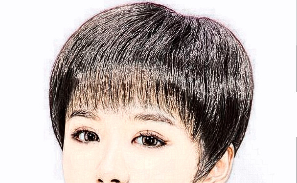 叢生植發(fā)植發(fā)一年案例點(diǎn)評(píng)(效果怎么樣?技術(shù)亮點(diǎn))