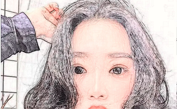 武漢希思特醫(yī)療美容醫(yī)院植發(fā)技術(shù)評價(jià)怎么樣?一年案例恢復(fù)過程