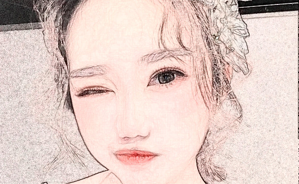 寧波藝星時(shí)代美容醫(yī)院脂肪填充費(fèi)用明細(xì)?半年術(shù)后恢復(fù)案例