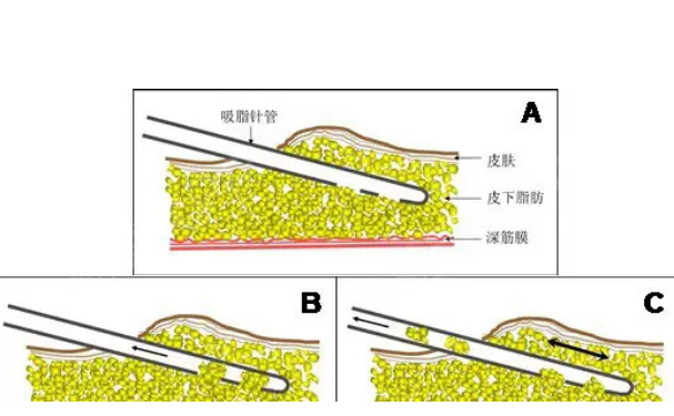 上海九院張國佑腰部抽脂90天案例&技術(shù)怎么樣?