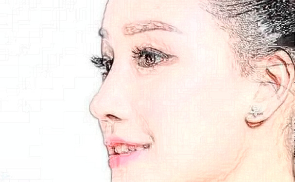 成都藝星謝雯面部提升求美案例&技術(shù)點評