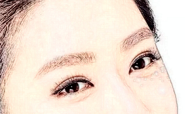 中南大學湘雅醫(yī)院雷少榕微創(chuàng)雙眼皮技術怎么樣?疑問解答|價格